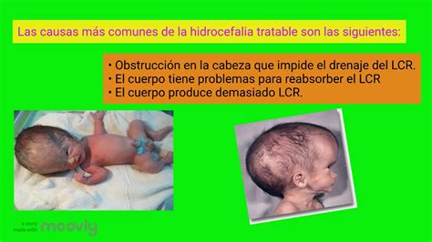 Hidrocefalia Neonatal Youtube