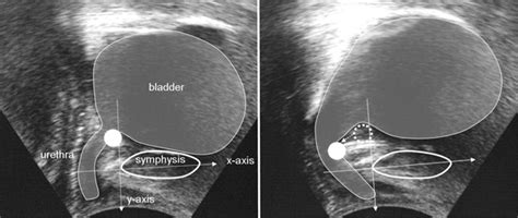 Perineal Ultrasound For Evaluating The Bladder Neck Mobility Bladder