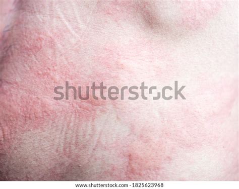 Urticaria On Skin Rashes Which Urticaria Stock Photo 1825623968