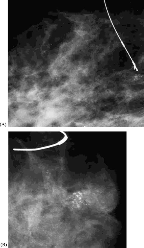Evaluation Of Breast Microcalcifications According To Breast Imaging Reporting And Data System