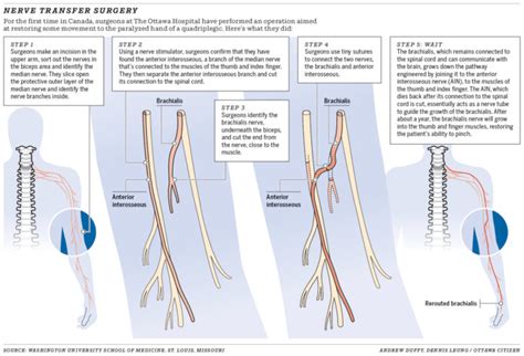 Qanda Nerve Transfer Surgery Answers Spinal Cord Injury Zone