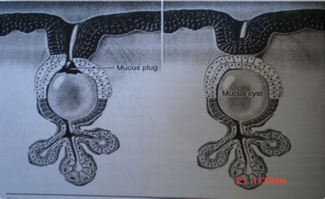 Notes On Mucocele And Mucous Retention Cystetiology