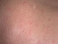 Who get affected by viral rashes? Viral exanthem