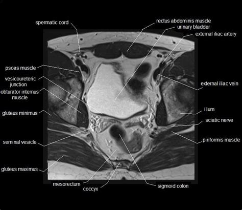 Pelvis Muscles Mri Anatomy Mri Anatomy Of Hip Joint Free Mri Axial Hip Anatomy This