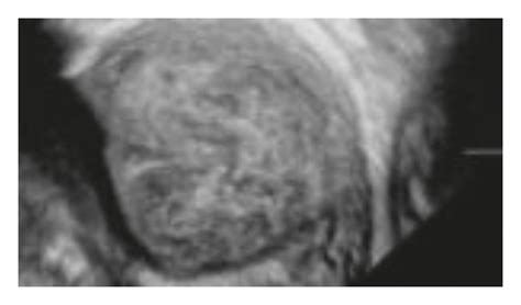 The Value Of Three Dimensional Tomographic Ultrasound Imaging Under