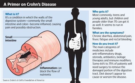In The Lab New Hope For Crohns Sufferers Wsj