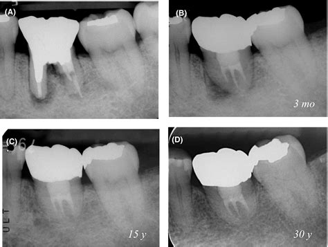 Long‐term Outcomes Of Autotransplantation Of Teeth A Case Series