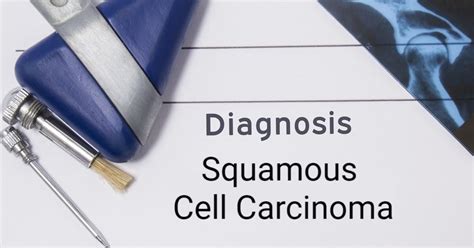 Understanding Squamous Cell Carcinoma Causes Symptoms And Treatment