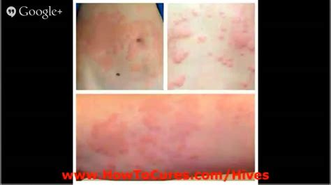 Urticaria Pictures Protocols For Soothing Acute Urticaria Urticaria