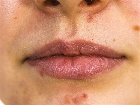 Acne Around Mouth Causes Prevention And Treatment