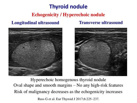 Types Of Thyroid Nodules Ultrasound