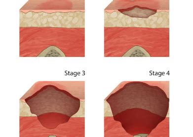 Stage Pressure Ulcers Explained Sinel Olesen Pllc