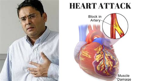 Life After Heart Attack How To Manage Anxiety And Depression After A