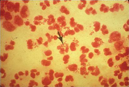 A microbial biorealm page on the genus neisseria gonorrhoeae. Gonococcus: Neisseria gonorrhoeae | Oncohema Key