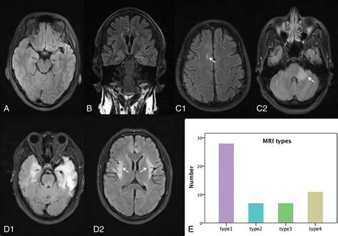 Brain Mri Characteristics Of Patients With Anti N Methyl D Aspartate