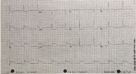 Cureus Diagnosis And Management Of An Inferior St Elevation