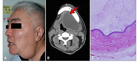 Figure 1 From Two Cases Of Giant Epidermal Cyst Occurring In The Neck
