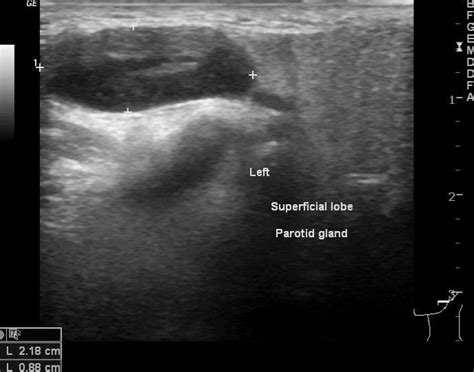 Enlarged Parotid Lymph Node Image
