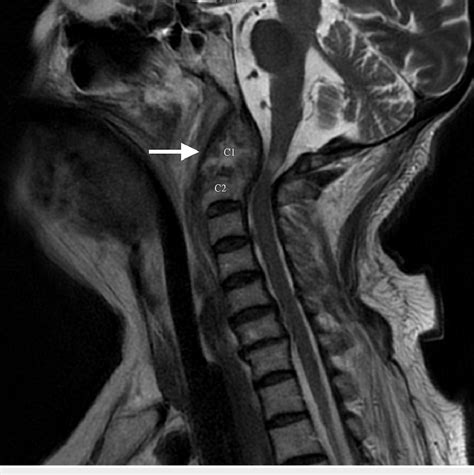 Mri Cervical Spine Reveals Pannus Formation Arrow At C1 C2 Region