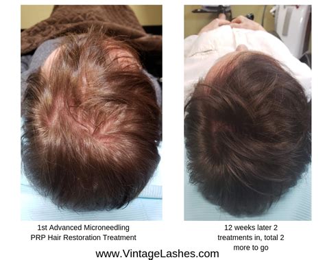 Advanced Microneedling Prp Hair Restoration Treatment Sw Florida