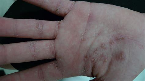 Acd A Z Of Skin Scabies