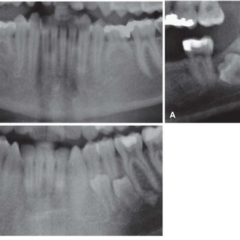 Dental Related Anomalies A An Impacted Right Second Premolar With A