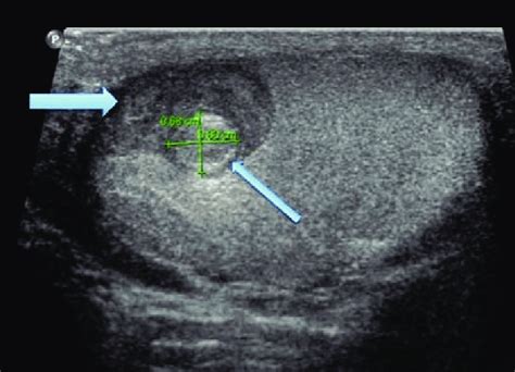 Testicular Hernia Ultrasound