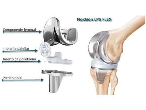 cirugía de protesis de rodilla cómo se realiza la operación y cómo es su rehabilitación