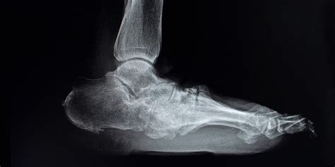 Charcot Foot And Ankle Diagnosis Benefits Of A Multidisciplinary