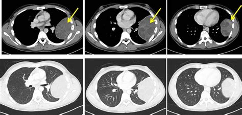 Pleural Based Mass Radiology Cases