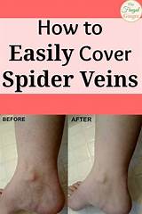 Pictures of Leg Vein Covering Makeup