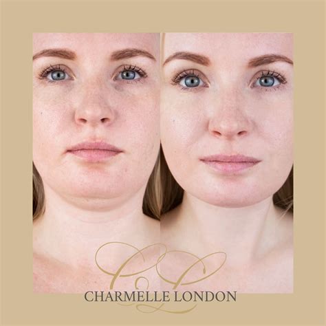 Aqualyx Fat Dissolving Injections In London Charmelle London