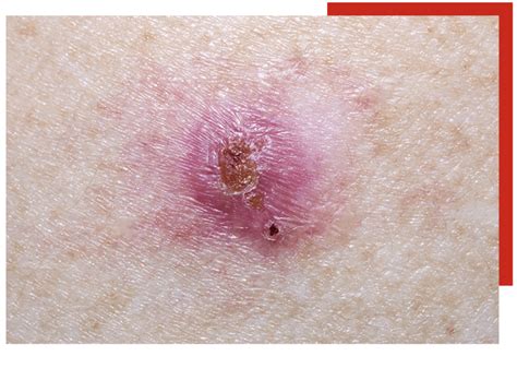 Skin Cancer Spots On Back