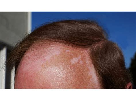 Ways To Check Your Scalp For Skin Cancer Huntington Ny Patch