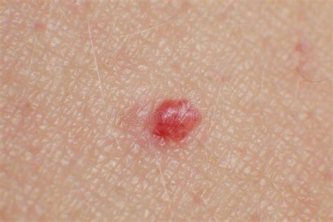 Cherry Angiomas On Male Skin Super Macro Close Up Stock Image Image