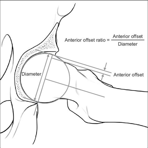 Alpha Angle The Angle Between The Line From The Femoral Head Center