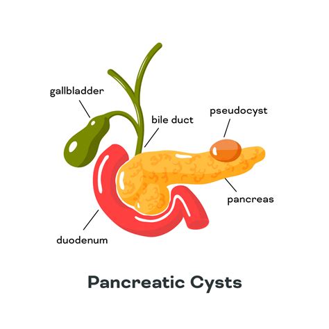 Pancreatic Cysts In Singapore Gastrohealth Centre