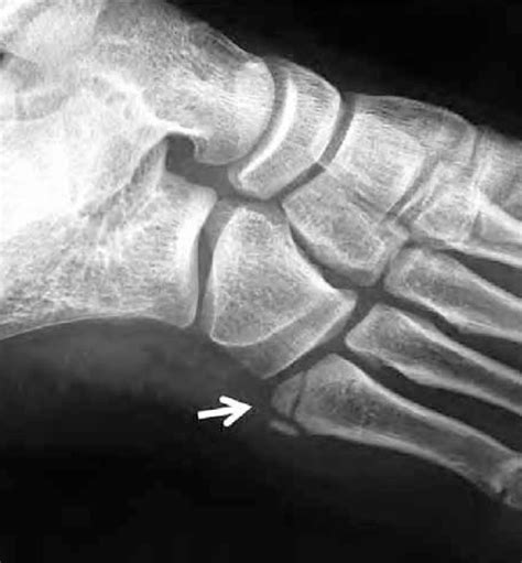 Foot X Ray Of A 10 Year Old Male Patient White Arrow Indicates