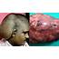 Man Let Massive Head Tumor Grow For 20 Years Over Alleged Fear Of 