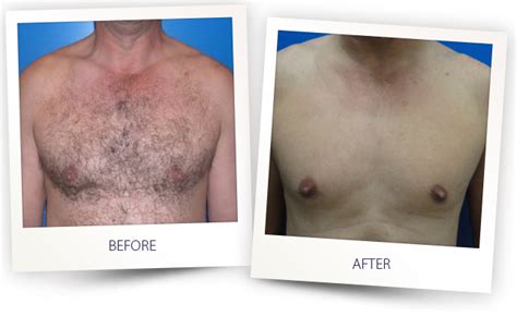 Some men prefer a very smooth, hairless chest appearance, while others just wish to thin some of the unwanted chest hair. The Best Laser Hair Removal in Los Angeles | LA Beauty ...