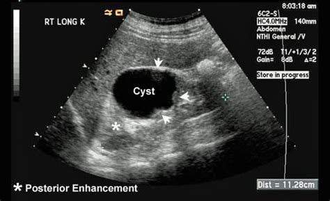 Untitled Document Medical Ultrasound Ultrasound Kidney Cyst