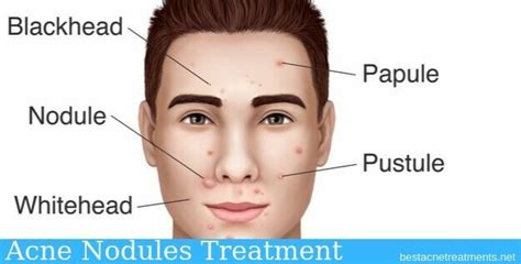 Acne Nodules Treatment Acne Nodules Treatment That Actually Works