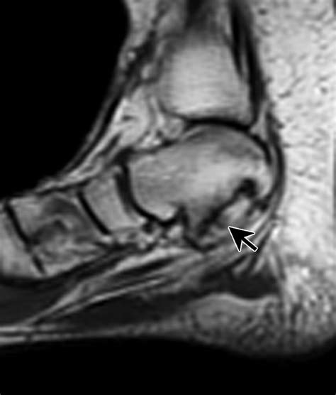 Talocalcaneal Coalition Mri