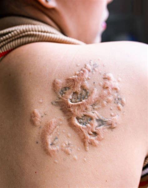 Specifically, your tattoo artist goes over the skin again to recolour the scarred area to hide the scar. Why is My Tattoo Raised? 2021 Information Guide