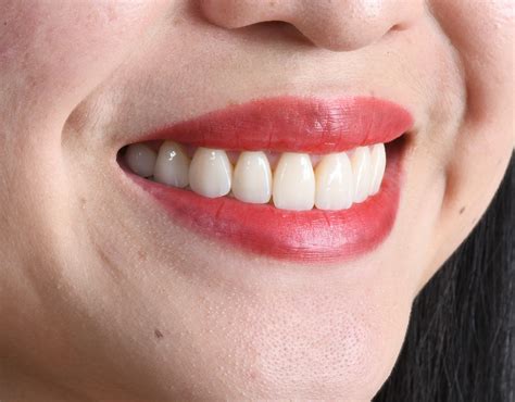 What can i say the boy is fine as hell. Dental Veneers - Casa Dental