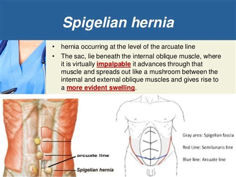 Study Medical Photos Brief Description Of Abdominal Wall Hernias