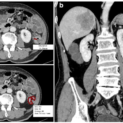 Tumor Size Measurement Using Enhanced Ct In A 73 Year Old Man With