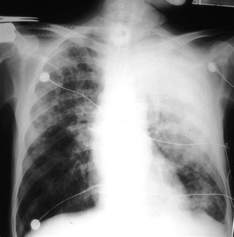 The disease is caused by the bacterium burkholderia pseudomallei. Melioidosis: an important cause of pneumonia in residents ...