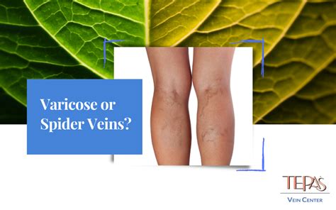 Varicose Veins Or Spider Veins Easily Know Which And The Risks Tepas