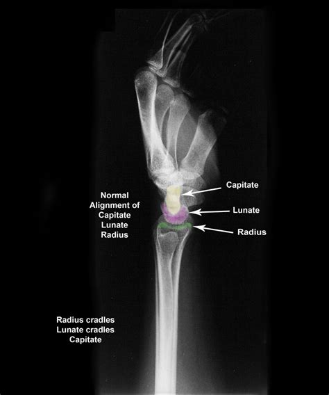 Normal Lat Wrist Copy